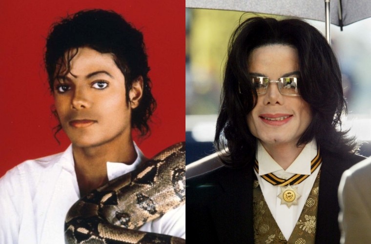 How Did Michael Jackson's Skin Turn White As He Got Older?
